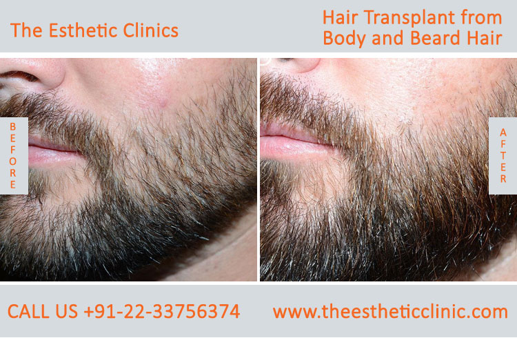 Hair Transplant from Body and Beard Hair before after photos mumba (3)